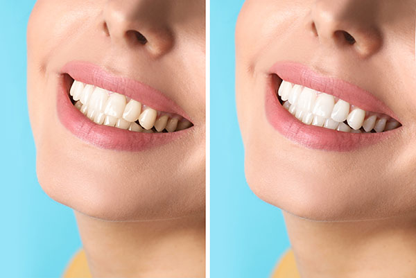 Cosmetic Dental Services With Natural Tooth Color from Sai Dental Care in Santa Rosa, CA
