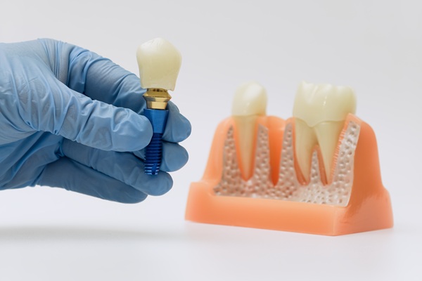Tooth Replacement    : The Long Term Health Benefits Of Dental Implants