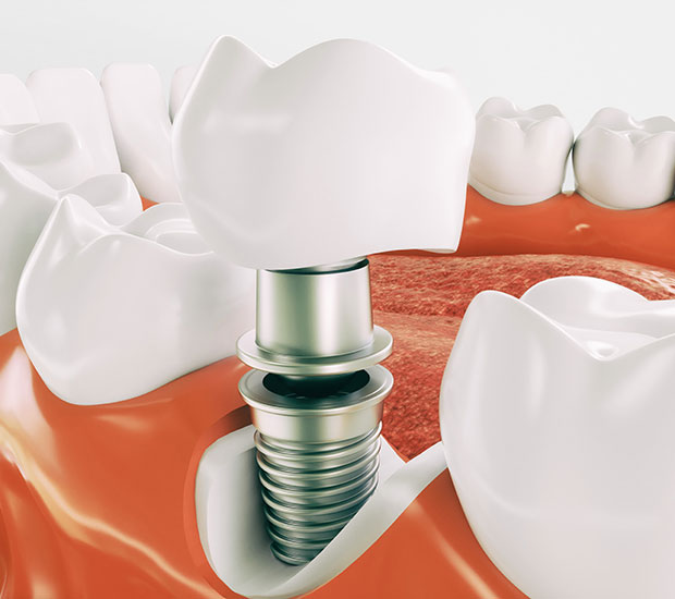 Santa Rosa Dental Implant Restoration