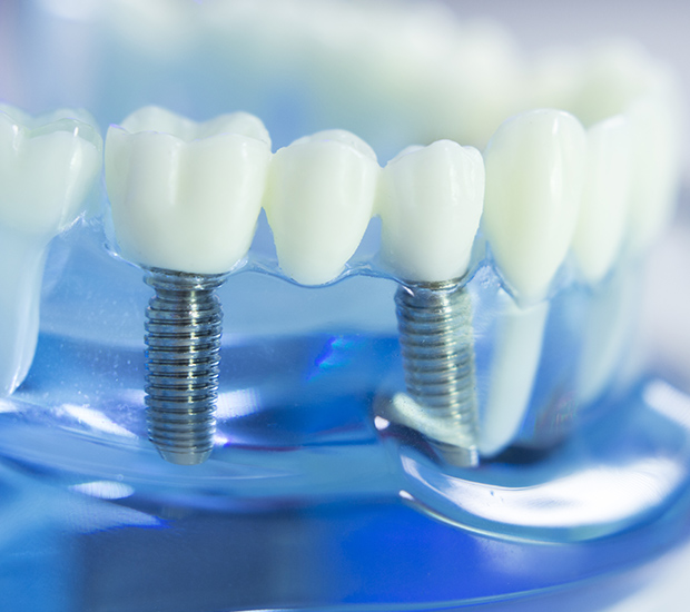 Santa Rosa Dental Implants